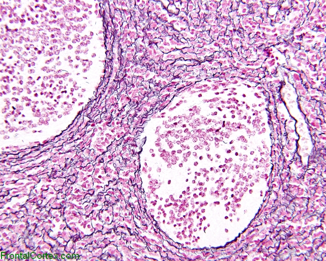 Desmoplastic medulloblastoma, reticulin histochemistry x200